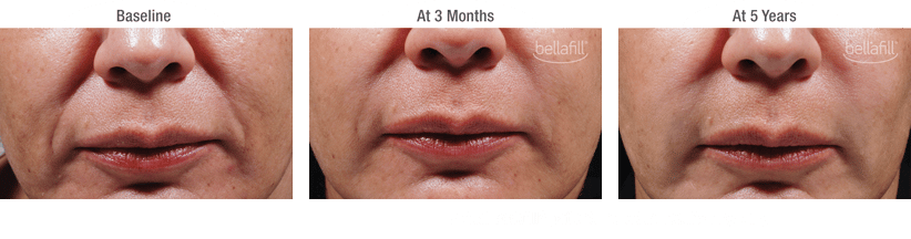 bellafill results