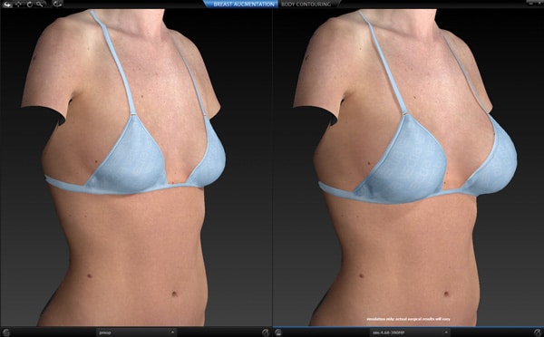 Before & After 3D Vectra Imaging Near St Peters MO and St. Louis, MO