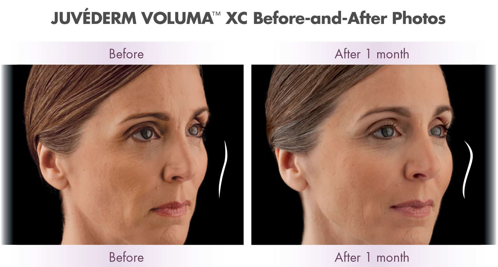 voluma results before and after renaissance plastic surgery