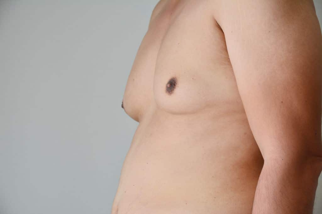 close up of a mans chest, he is a prime candidate for a male breast reduction.