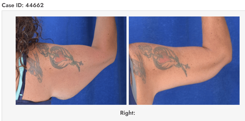 Brachioplasty Before & After Photos