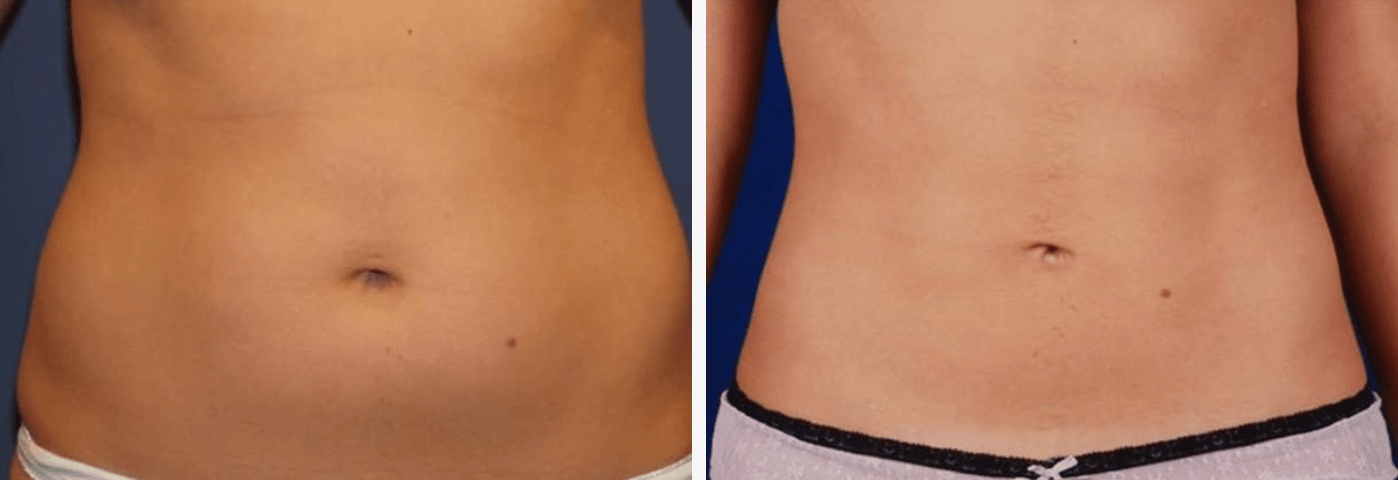 Liposuction Stomach Before & After Image