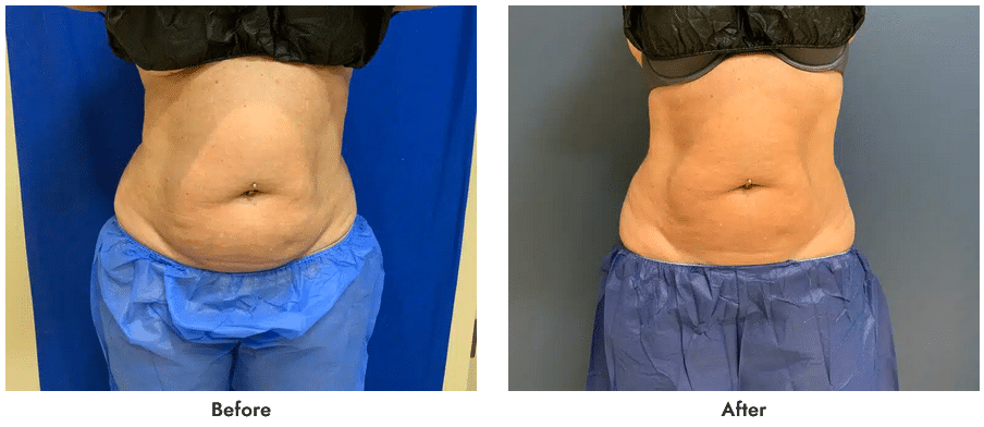 CoolSculpting Featured Case 1