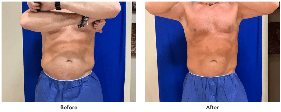 Male CoolSculpting Featured Case 1